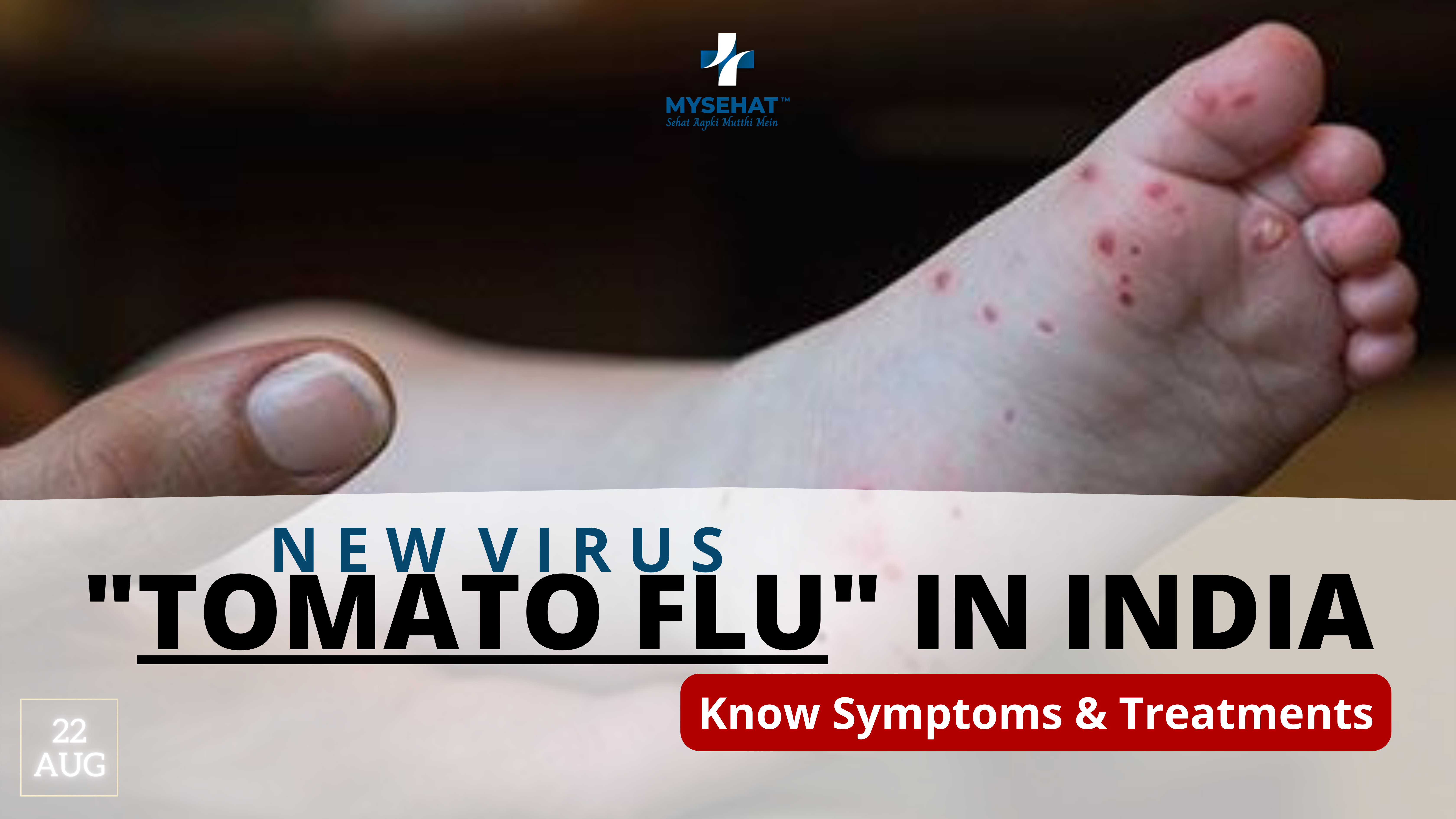 ‘Tomato flu’ virus reaches India, infecting children in Kerala